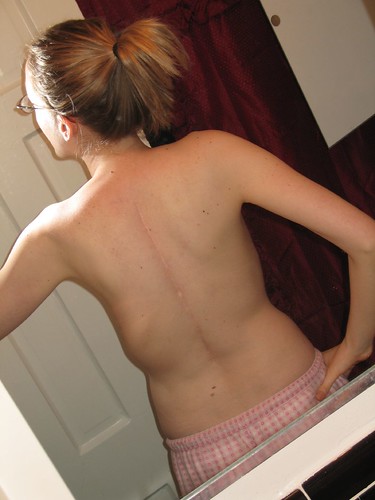 Scoliosis Surgery Scars