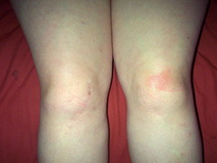 knee inflammation