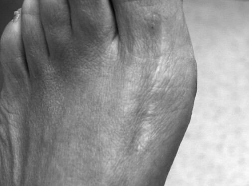 Bunions On Feet. Tags: feet foot toes skin