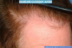 Propecia Hairline