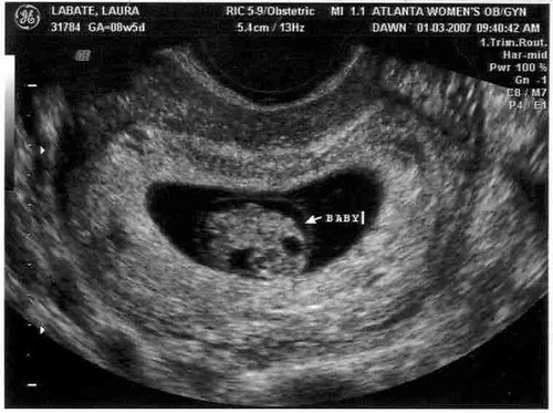 ultrasound 8 weeks. Ultrasound - 8 weeks 5 days