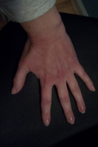heat rash on hands and feet. on [[hands]] and [[feet]].