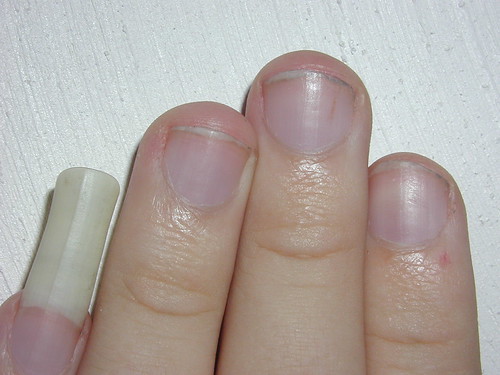 Healthy fingernails and fingernail problems: Splitting ...