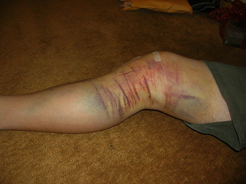 bruised  knee