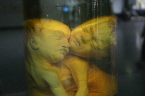 Young victims of the terrible Vietnam/American war. Chemical herbicides spred by the US caused these deformed babies