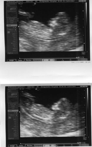 First scan of our new bump!
