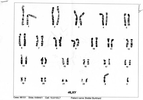 chromosome translocation