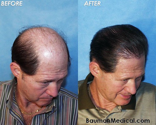 tom brady hair transplant. Bauman says: Hair restoration
