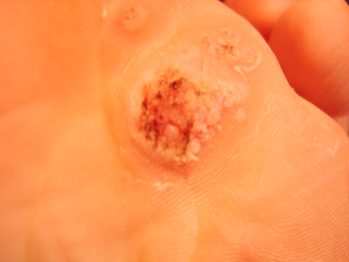 common wart on hand. and vulgaris,common skin