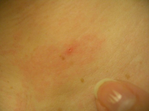 Bed bug bites: photos and information