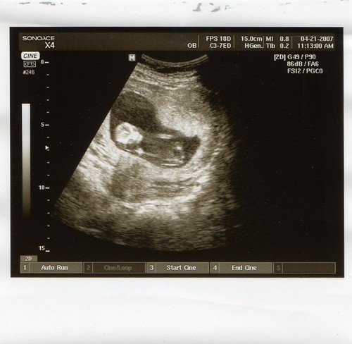 fetus at 12 weeks. L.A. Fetus is 12 weeks old