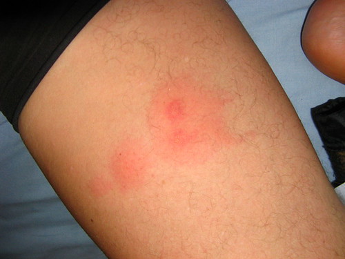 Bed Bug Bites Photos And Information