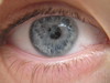 retinitis pigmentosa treatment