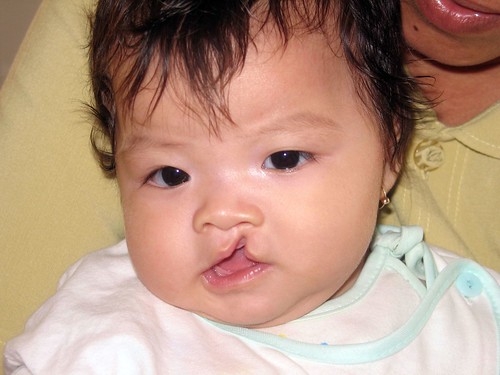 cleft lip before and after. Cleft Baby Before Surgery