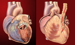 Human heart, anterior view, artificial valve, ...