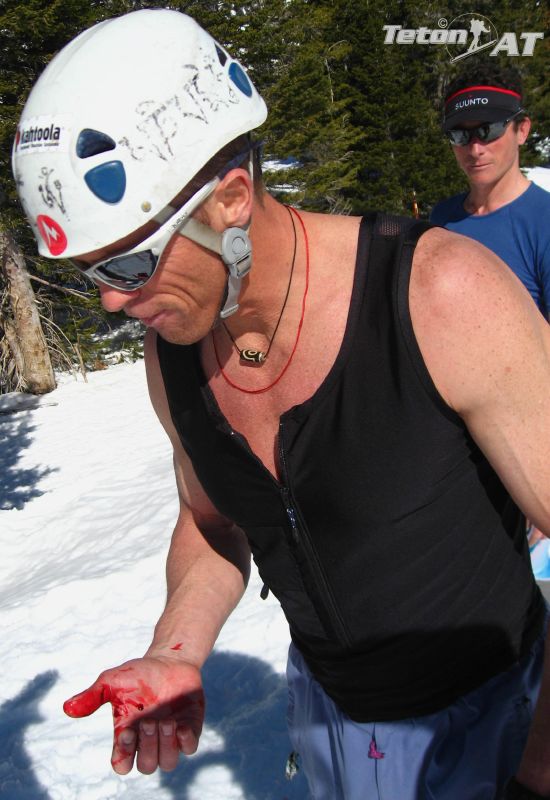 Brian Harder slices his hand on his skis