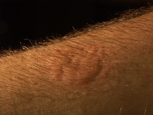 bed bugs signs. dorsal view of arm, ed bug