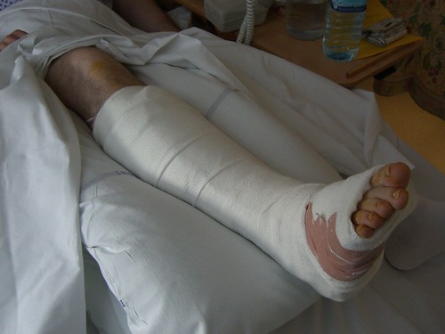 The cast - A Significant Leg Injury Can Put You Out Of Action For A While