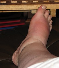 My swollen feet