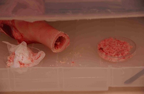 Harvesting Bone Marrow for Tissue Cultures