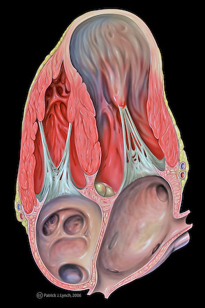 NCCT brain showing right parietal extradural hematoma with 