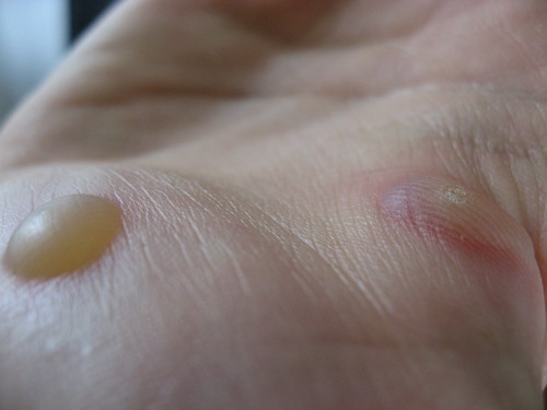 common wart on hand. What Causes Warts On Hands