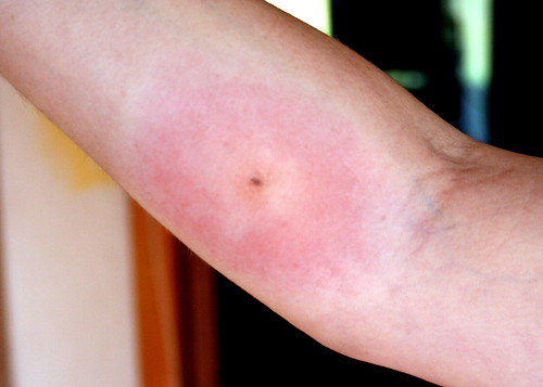 spider bites pictures on humans. it was a spider#39;s bite