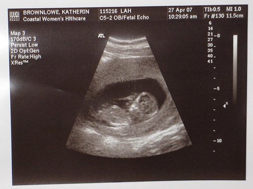 fetus at 12 weeks. Fetus 12 weeks. It#39;s what the title says it is.it#39;s my fetus!