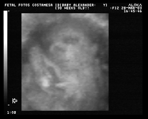 3d ultrasound scan. Related Fetal 3d Ultrasound
