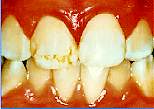 Dental fluorosis from fluoride