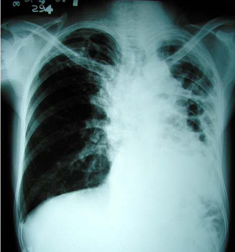 tuberculosis x ray. This is the x-ray of a 40 year