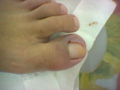 Ingrown toenail.