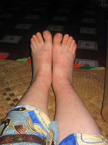 swelling in the legs