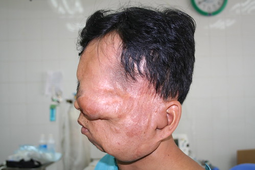 Tumor Patient Phuong by interplast.