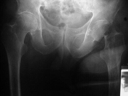 osteoporosis x ray. of getting osteoporosis