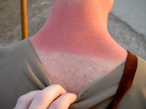 Oparzenie słoneczne skóry