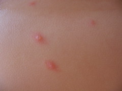 Chicken pox in process