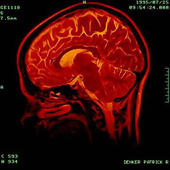 prd brain scan