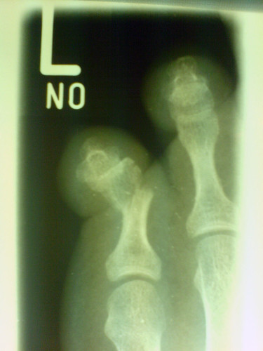 broken toe splint. roken toe xray bones