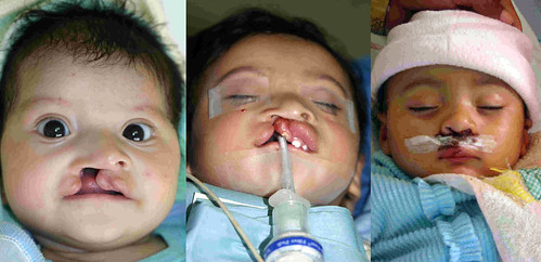 cleft lip before and after. Ortiz#39;s cleft lip: efore,