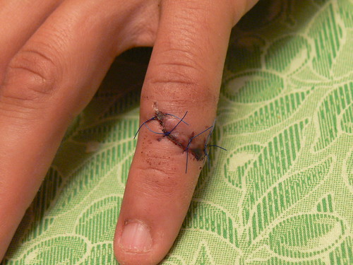 Points de sutures
