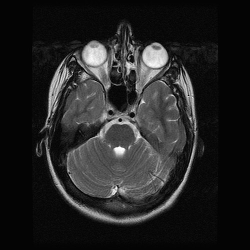 mri brain scan. 20060508 - Carolyn#39;s MRI