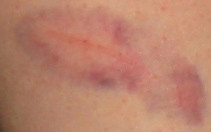 20060602 - 100-0100 - Carolyn's bruise