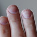 Fingernail Side Effects
