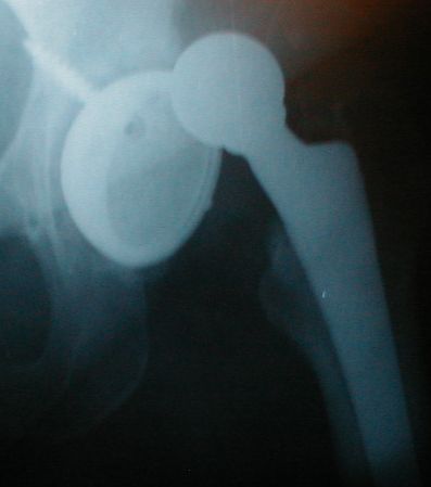DePuy Hip Implants Blamed for Faulty California Hip Surgeries 1