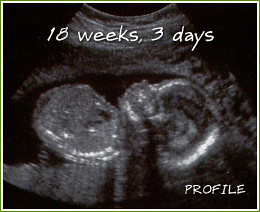 Ultrasound at 18 weeks, 3 days