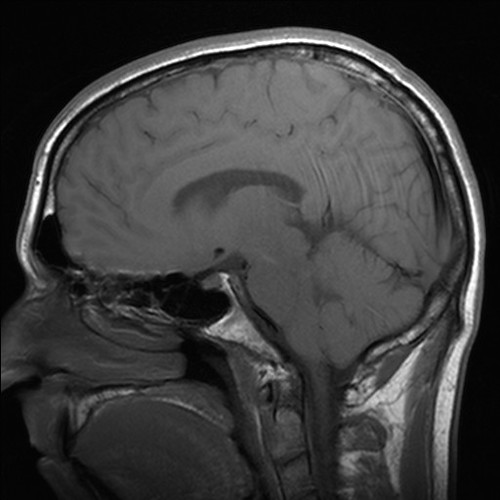 Signs & Symptoms of Thalamus Brain Tumor | Healthfully