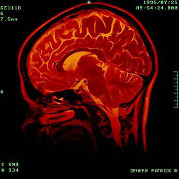 prd brain scan by Patrick Denker, on Flickr