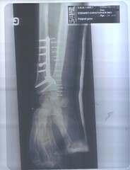 Fracture : metal plate I