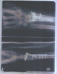 Fracture : metal plate II